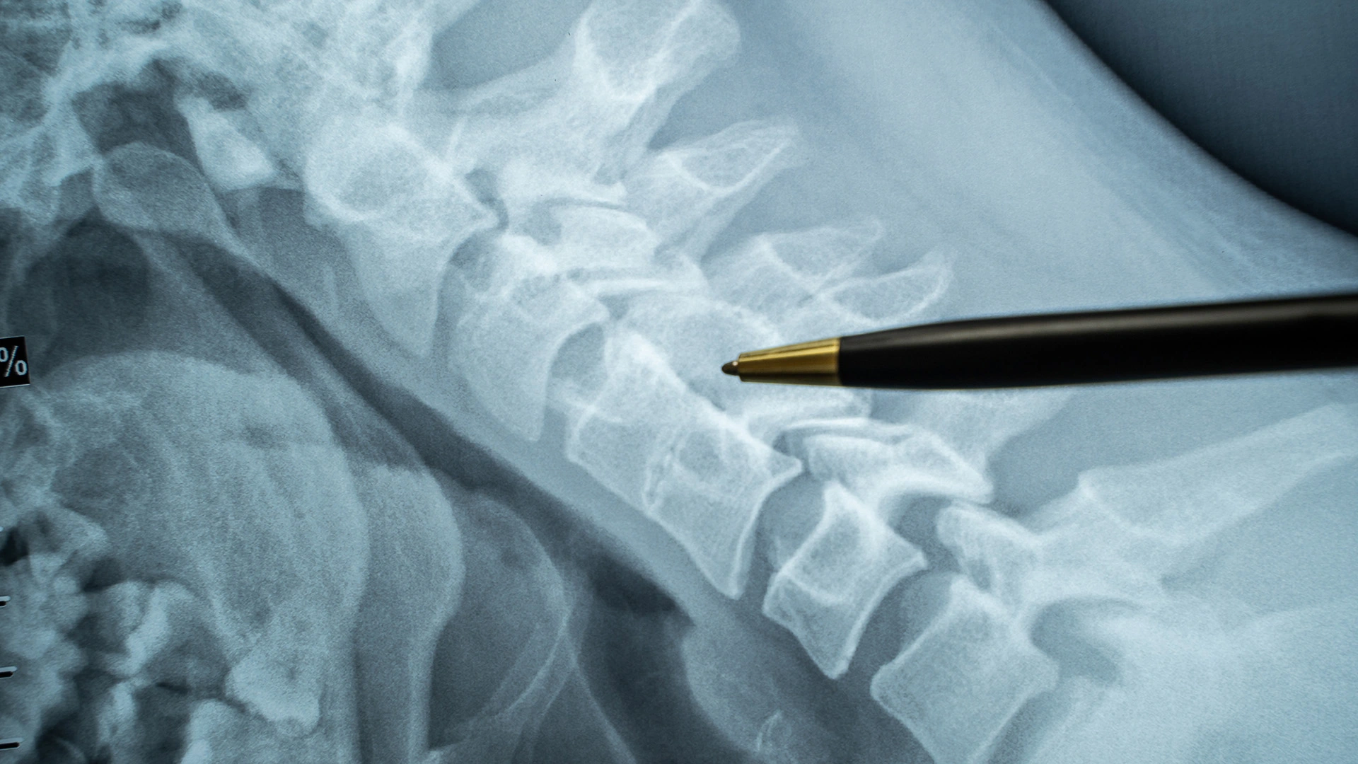 Doctor reviewing spine CT scan for epidural procedure