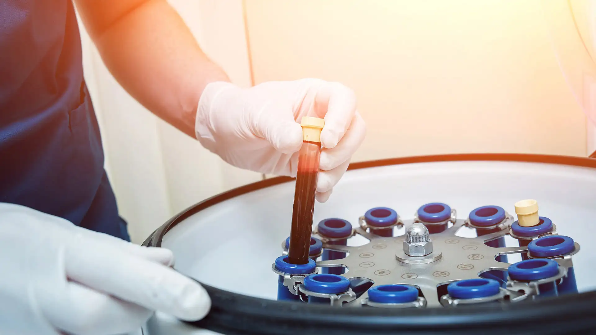 Platelet-rich plasma preparation in centrifuge tube