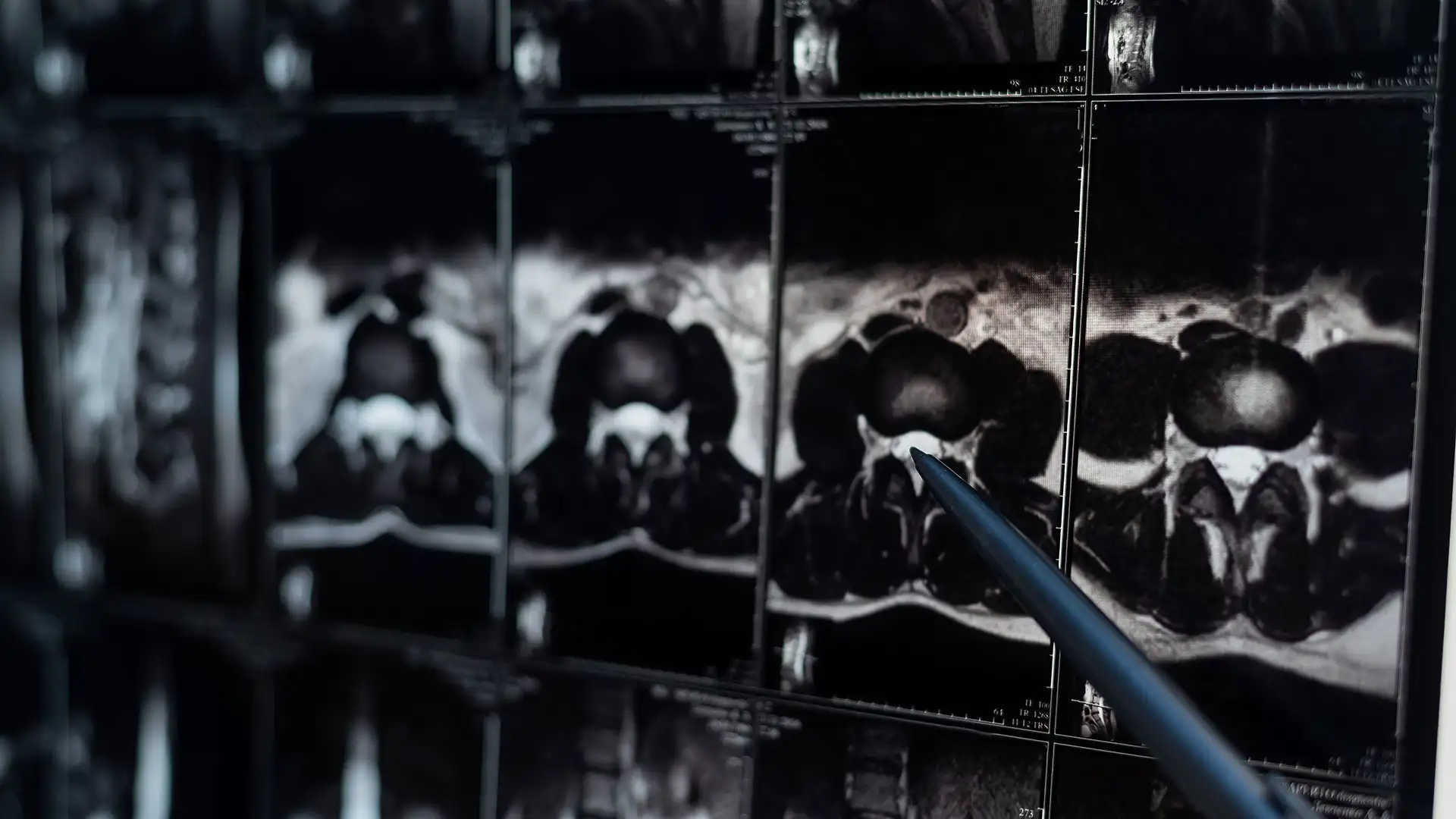 Doctor pointing at lumbar spine MRI scan