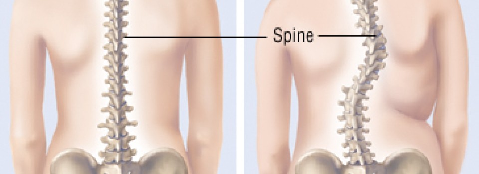 Scoliosis