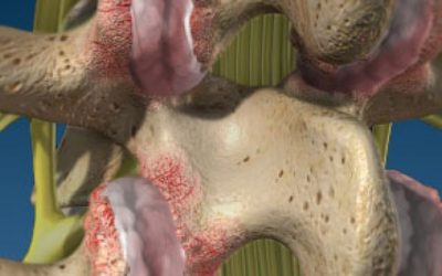 Facet Joint Syndrome (Arthritis)