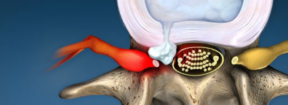 herniated_discs_blue