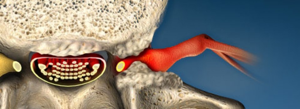 spinal stenosis blue (1)
