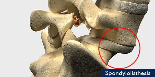 spondylolisthesis 2