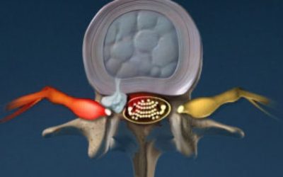 Where Back Pain Begins