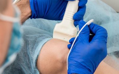 Radiofrequency Ablation