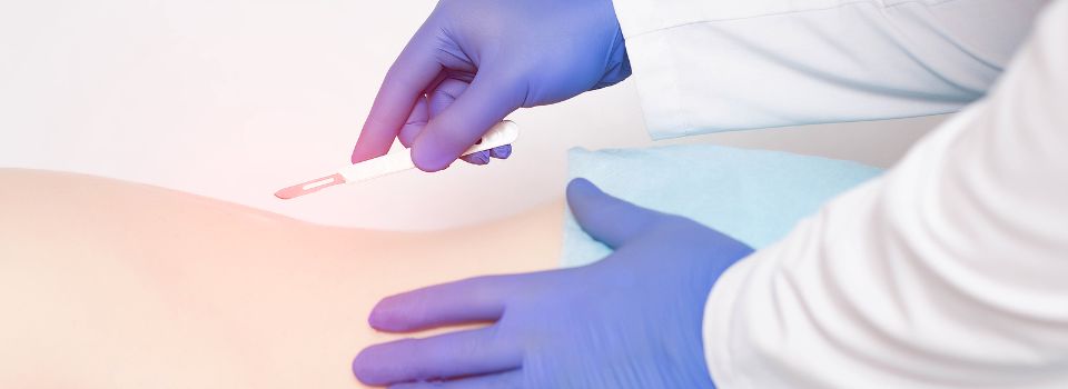 Spinal Cord Stimulation