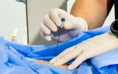 Sacroiliac Joint Steroid Injection