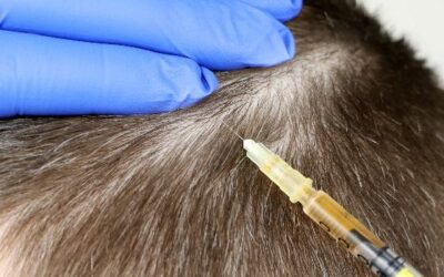 Occipital Nerve Block